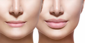 Lip Reduction Surgery Trends in Indian Women